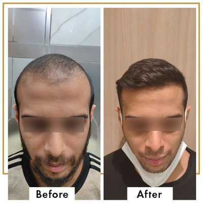 Hair Transplant result