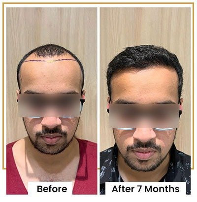 Best Hair Transplant in Mumbai
