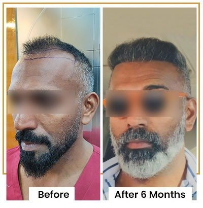 Hair transplant for NRI in Mumbai