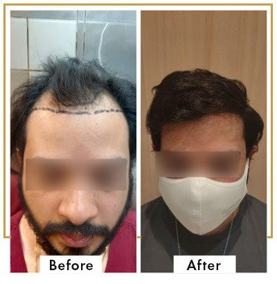 Hair-Transplant-results