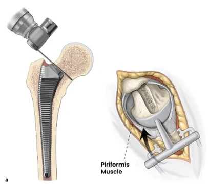 Hip Replacement in bangalore