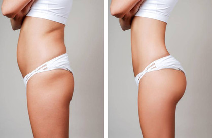Liposuction Surgery cost in mumbai