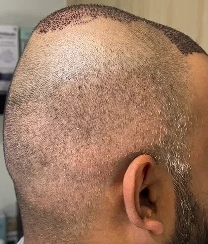 Micro FUE Hair Transplant in Mumbai