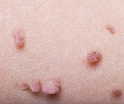 Skin Tag Removal in Mumbai