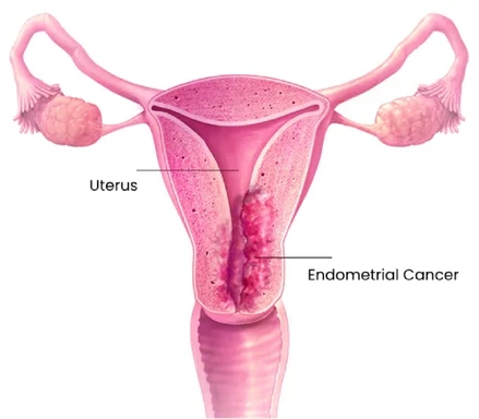 Dr Maitreyee Parulekar – Endometrial Cancer Surgery Specialist Mumbai Doctor Near Me Endometrial Cancer Surgery in Mumbai