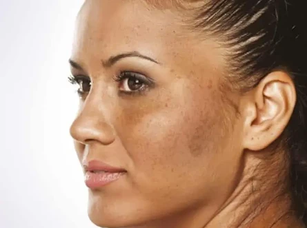 hyperpigmentation treatment in mumbai
