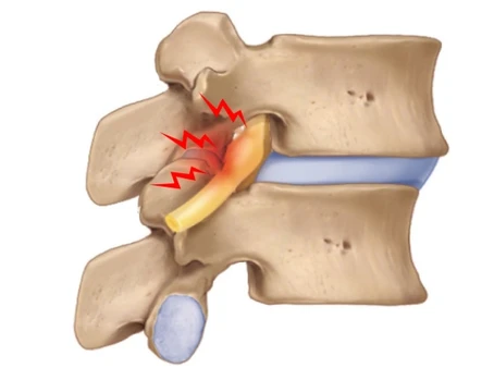 Spondylolisthesis treatment in  mumbai