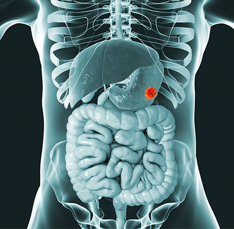 Gastric Cancer Treatment in Mumbai