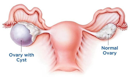 My Visit to a Leading Clinic for Ovarian Cyst Surgery in Mumbai Doctor Near Me Ovarian Cyst surgery in Mumbai
