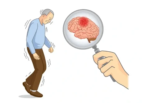 Best Doctor for parkinsons in Mumbai