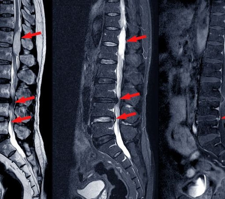 A First-Hand Look at Lumbar Spine Stenosis Treatment In Mumbai Doctor Near Me Lumbar Spine Stenosis Treatment In Mumbai