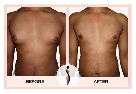 gynecomastia surgery in mumbai