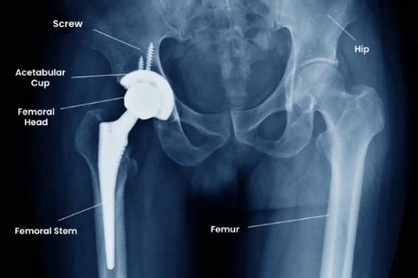 total hip replacement surgery in bangalore