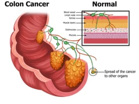 Colorectal Cancer Treatment in Mumbai