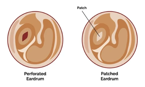 tympanoplasty surgery in mumbai