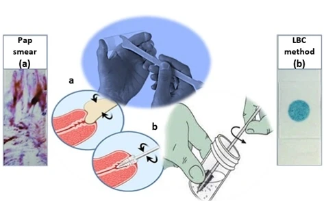 Cervical cancer surgery in mumbai