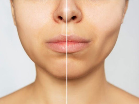 Understanding Facial Sculpting: Insights into Buccal Fat Removal Surgery Cost in South Mumbai Doctor Near Me