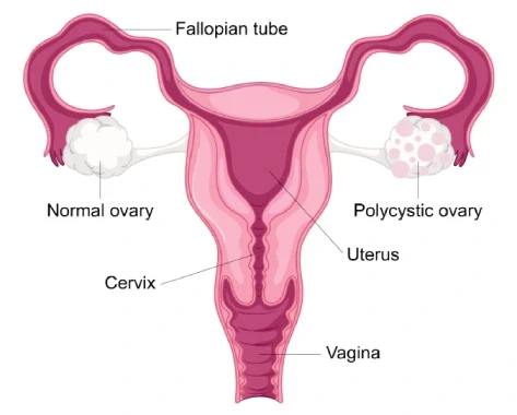 Menstrual Disorders Treatment in Mumbai | Dr Parulekar Doctor Near Me menstrual disorders treatment in mumbai