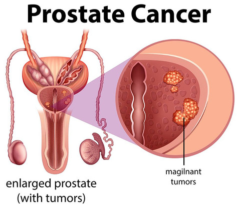 prostatecancer.jpeg