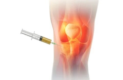PRP Knee Injection in Dubai – Dr. Azam Badar Khan