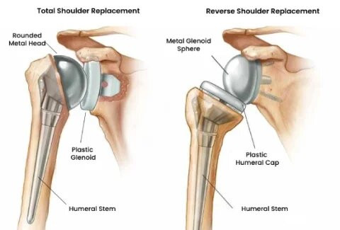 Total Shoulder Replacement in Bangalore: Dr. Ponnanna K.M