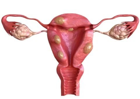 Robotic Fibroid Surgery in Mumbai | Dr. Maitreyee Parulekar