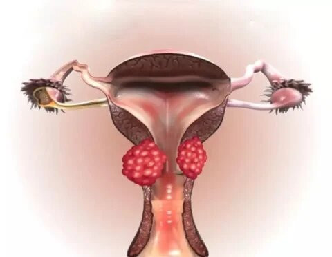 Cervical Cancer Surgery in Mumbai: Expert Care by Dr. Maitreyee Parulekar Doctor Near Me