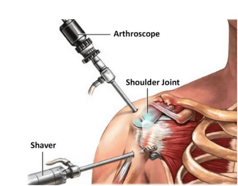 Arthroscopic Capsular Release for Frozen Shoulder in Bangalore