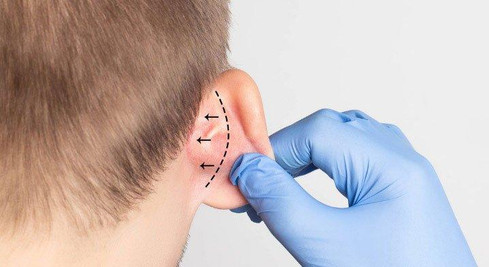 Best Ear Reconstruction Surgeon in Mumbai
