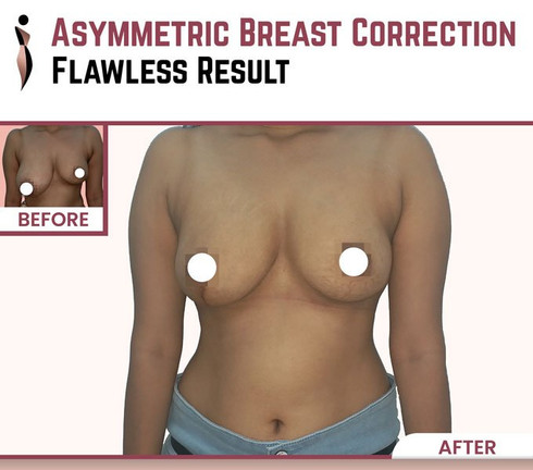 Inside the Clinic: A Medical Journalist’s Perspective on Breast Asymmetry Correction in Mumbai Doctor Near Me breast asymmetry correction in mumbai