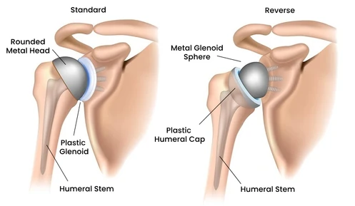 Reverse Shoulder Replacement in Bangalore