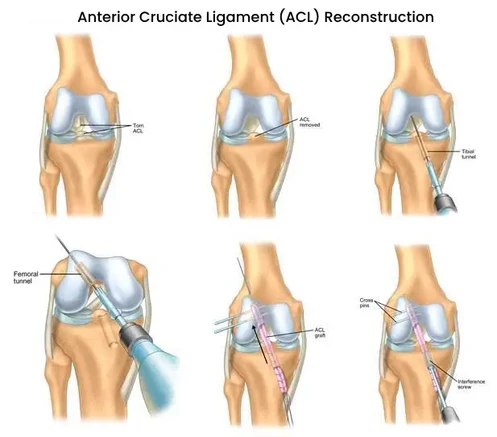 arthroscopicaclreconstructioninbangalore.webp