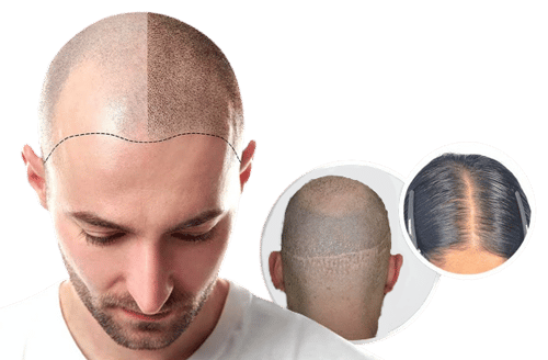 Hair Transplant Cost In mumbai