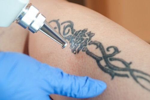 Laser Tattoo Removal in Mumbai with Dr. Niketa Sonavane