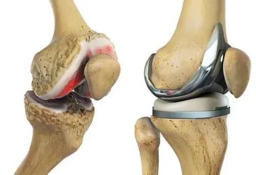 Knee replacement In bangalore