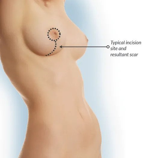 Breast Lift Surgery in Mumbai
