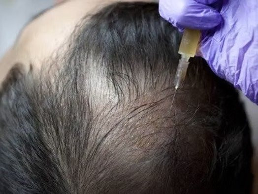 Hair Loss Treatment in Mumbai