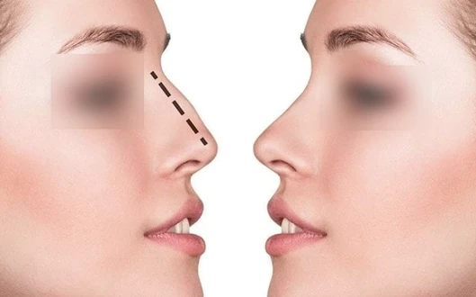 Septoplasty Surgery in Mumbai