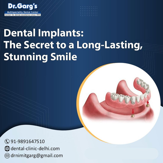 dentalimplantsthesecrettoalonglastingstunningsmile.jpg