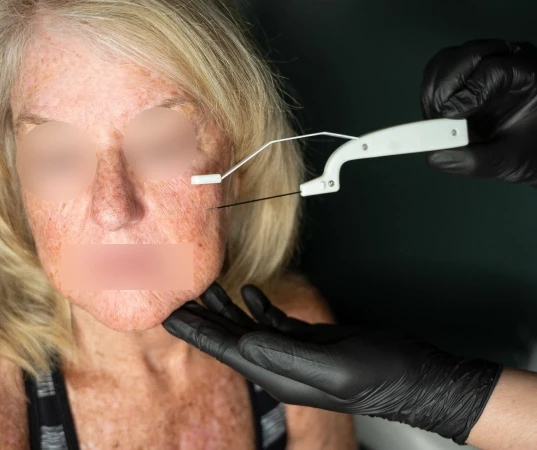 AccuTite Treatment in Mumbai | Dr Devayani Barve Doctor Near Me AccuTite Treatment in Mumbai