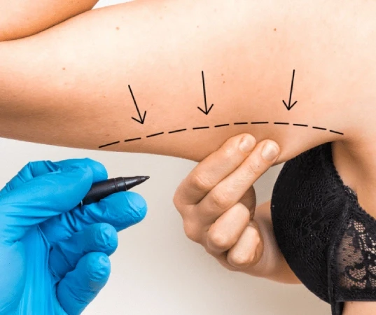 Arm Lift Surgery in Mumbai