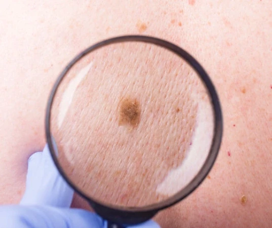 Skin cancer treatment in Mumbai