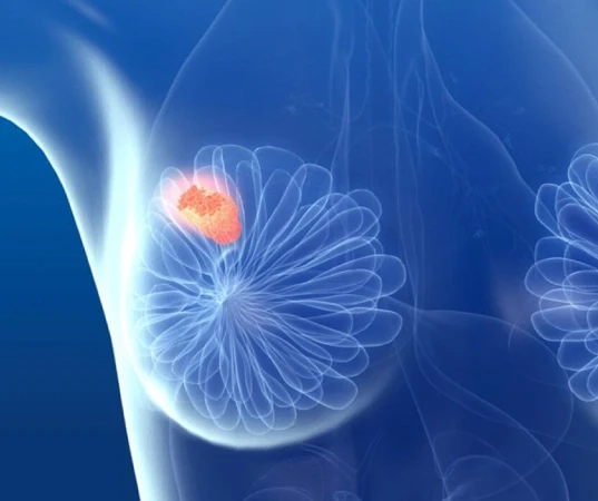 Fibroadenoma Surgery in Mumbai