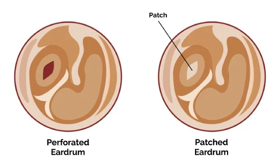 Tympanoplasty Surgery in Mumbai