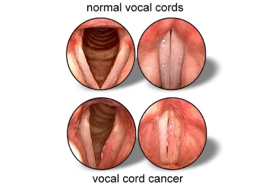 Vocal Cord Cancer Treatment in Mumbai