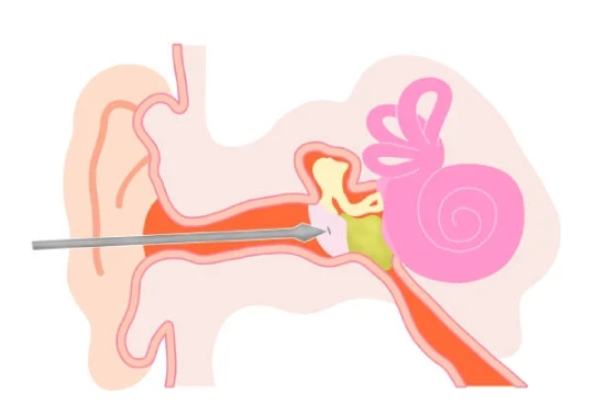 Best Myringotomy Doctor in Mumbai