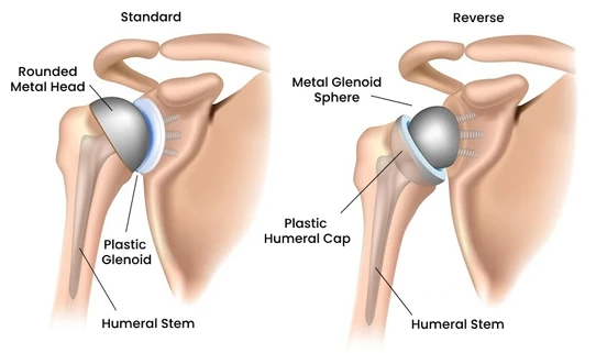 Reverse Shoulder Replacement in Bangalore