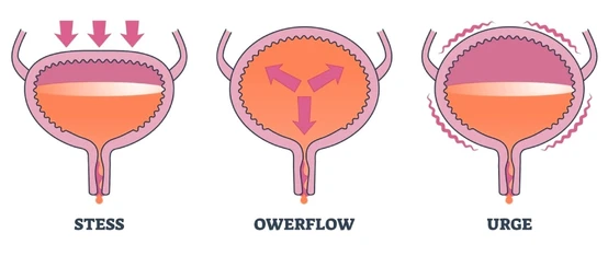 Urinary Incontinence Treatment in Mumbai – Dr. Maitreyee Parulekar Insight Doctor Near Me Urinary Incontinence Treatment in Mumbai