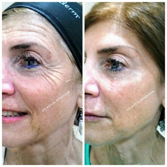 Botox Treatment in Mumbai