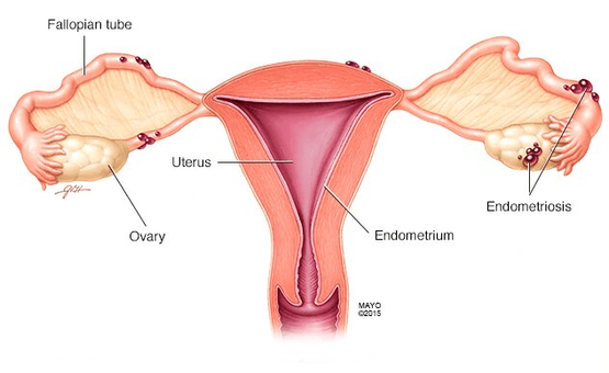 Endometriosis Specialist in Andheri West